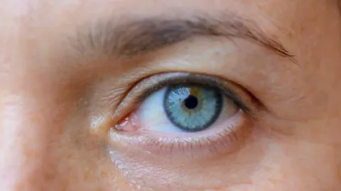 Blefaroplastie (Chirurgia Pleoapelor)